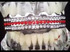 Silver Tone Three Row Red Iced Flooded Out  Top Teeth Grillz