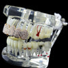 14K Rose Gold Plated Micro Pave Iced Top Teeth Grillz