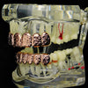 14k Rose Gold Plated Nugget Teeth Grillz Set