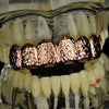 14K Rose Gold Plated Nugget Top Teeth Grillz