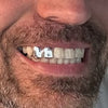 925 Sterling Silver Double Side Canine Teeth Caps Custom Grillz