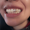 925 Sterling Silver Single Open Face Cap Custom Grillz (Choose Any Tooth)
