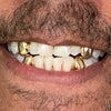 Real 10K Gold Four Single Caps w/Back Bars Custom Grillz