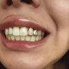 Real 14K Gold Double Side Canine Open Face Caps Custom Grillz
