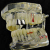 Silver Tone Double Caps Teeth Grillz - Left Hand Side