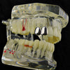 Silver Tone Double Caps Teeth Grillz - Right Hand Side