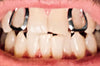 Silver Tone Open Face Single Top Tooth Cap Grillz