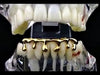 14K Gold Plated Bottom Teeth Melting Dripping Drip Grillz