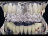 Silver Tone Micro Pave Iced Top Teeth Grillz