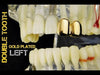 14K Gold Plated Double Caps - Left Hand Teeth